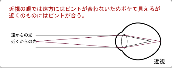 近視の焦点図